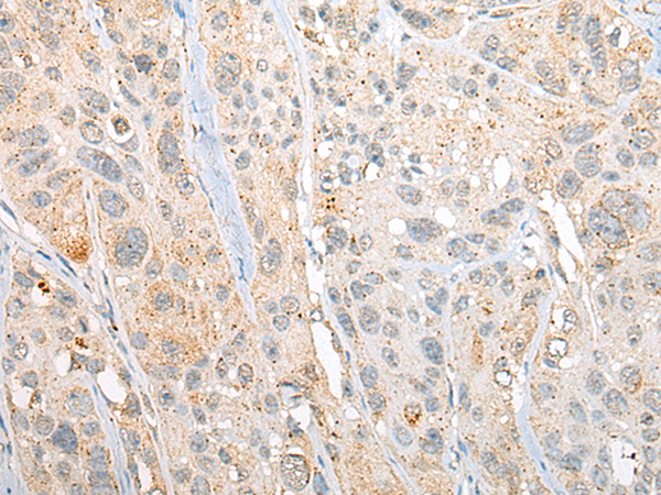Immunohistochemistry of paraffin-embedded Human esophagus cancer tissue using TA372344 (REM1 Antibody) at dilution 1/25 (Original magnification: x200)