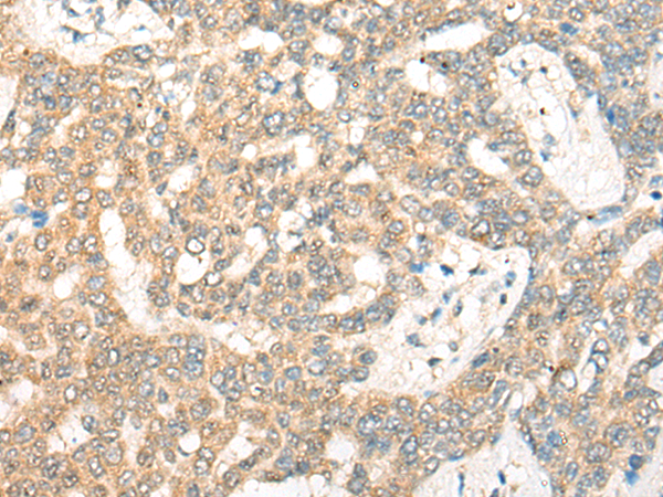 Immunohistochemistry of paraffin-embedded Human liver cancer tissue using TA372361 (GNB1L Antibody) at dilution 1/30 (Original magnification: x200)