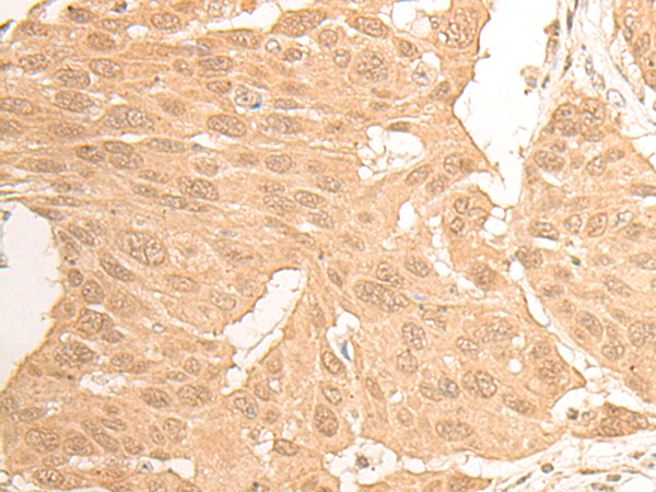 Immunohistochemistry of paraffin-embedded Human esophagus cancer tissue using TA372396 (DCAF13 Antibody) at dilution 1/20 (Original magnification: x200)