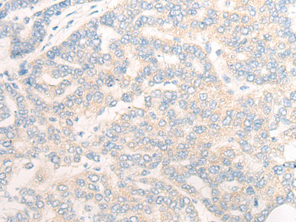 Immunohistochemistry of paraffin-embedded Human liver cancer tissue using TA372404 (SLC28A2 Antibody) at dilution 1/20 (Original magnification: x200)