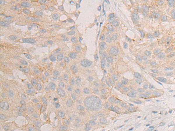 Immunohistochemistry of paraffin-embedded Human esophagus cancer tissue using TA372425 (DLEC1 Antibody) at dilution 1/20 (Original magnification: x200)