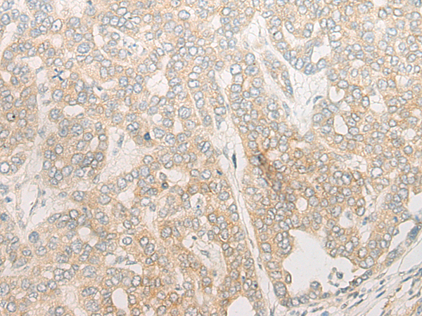 Immunohistochemistry of paraffin-embedded Human liver cancer tissue using TA372431 (POLG Antibody) at dilution 1/20 (Original magnification: x200)