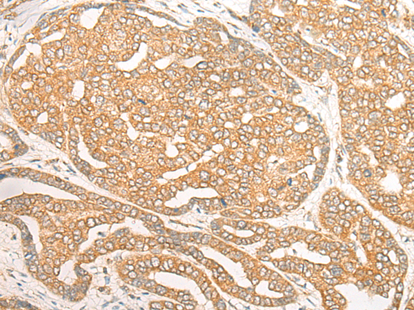 Immunohistochemistry of paraffin-embedded Human liver cancer tissue using TA372436 (DOC2B Antibody) at dilution 1/25 (Original magnification: x200)