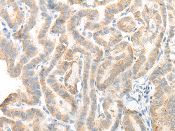 Immunohistochemistry of paraffin-embedded Human thyroid cancer tissue using TA372452 (MICU3 Antibody) at dilution 1/20 (Original magnification: x200)