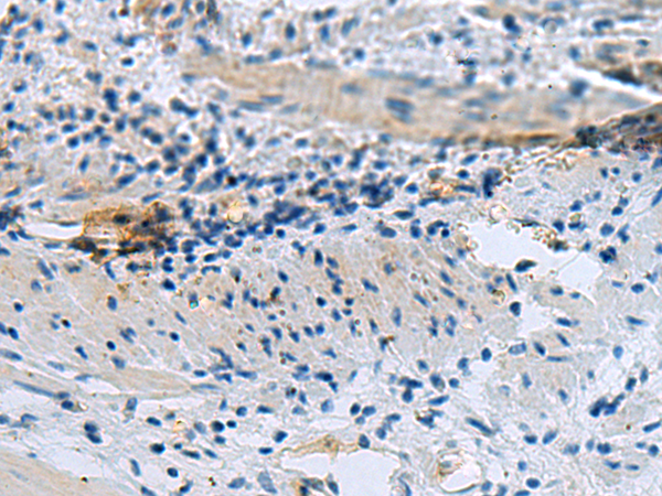 Immunohistochemistry of paraffin-embedded Human gastric cancer tissue using TA372506 (GSPT1 Antibody) at dilution 1/20 (Original magnification: x200)