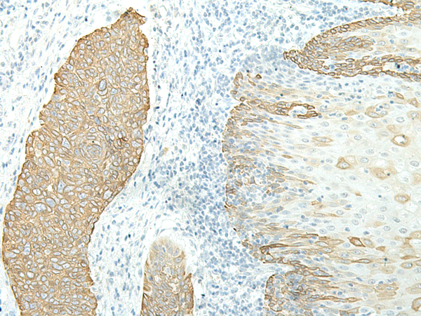 Immunohistochemistry of paraffin-embedded Human esophagus cancer tissue using TA372509 (ETAA1 Antibody) at dilution 1/40 (Original magnification: x200)