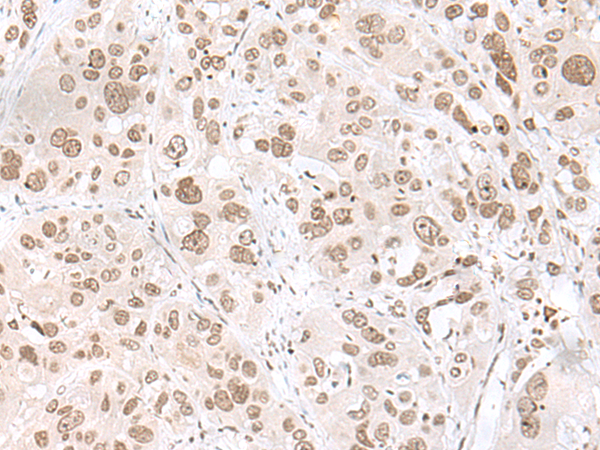 Immunohistochemistry of paraffin-embedded Human esophagus cancer tissue using TA372518 (EHMT2 Antibody) at dilution 1/20 (Original magnification: x200)