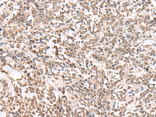 Immunohistochemistry of paraffin-embedded Human lung cancer tissue using TA372519 (ZNF560 Antibody) at dilution 1/35 (Original magnification: x200)