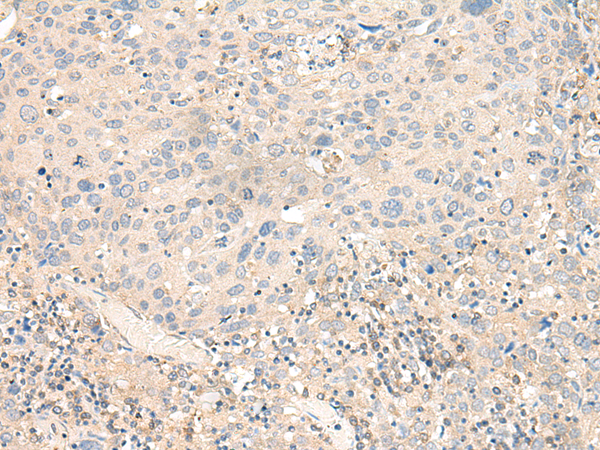 Immunohistochemistry of paraffin-embedded Human cervical cancer tissue using TA372526 (KCNA10 Antibody) at dilution 1/40 (Original magnification: x200)