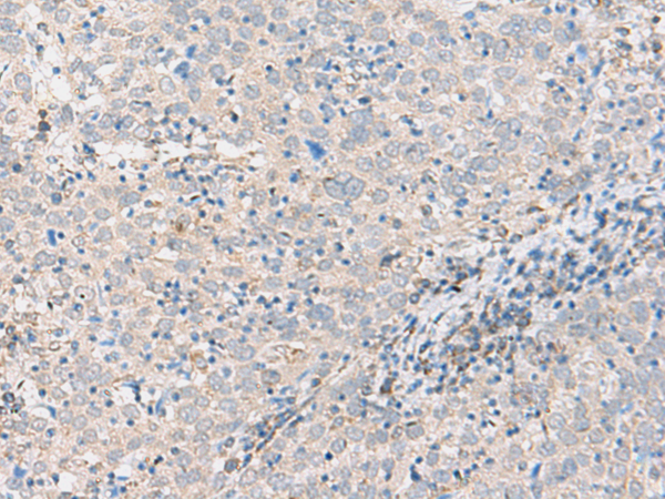 Immunohistochemistry of paraffin-embedded Human cervical cancer tissue using TA372535 (ABHD17B Antibody) at dilution 1/35 (Original magnification: x200)