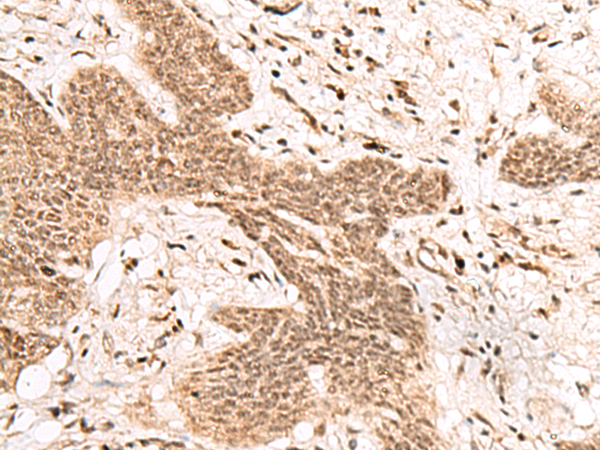 Immunohistochemistry of paraffin-embedded Human esophagus cancer tissue using TA372536 (FAM111B Antibody) at dilution 1/50 (Original magnification: x200)