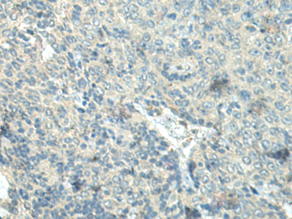 Immunohistochemistry of paraffin-embedded Human esophagus cancer tissue using TA372552 (FBXL16 Antibody) at dilution 1/25 (Original magnification: x200)