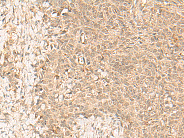 Immunohistochemistry of paraffin-embedded Human ovarian cancer tissue using TA372553 (FBXL4 Antibody) at dilution 1/25 (Original magnification: x200)