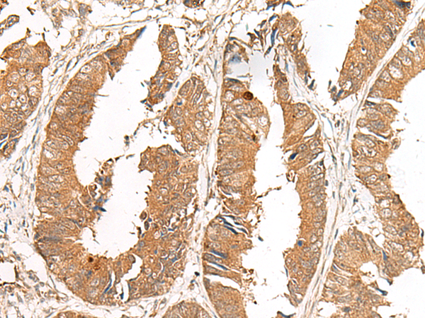 Immunohistochemistry of paraffin-embedded Human colorectal cancer tissue using TA372608 (GCC2 Antibody) at dilution 1/50 (Original magnification: x200)