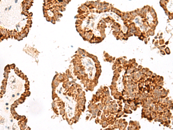 Immunohistochemistry of paraffin-embedded Human thyroid cancer tissue using TA372615 (GFI1B Antibody) at dilution 1/40 (Original magnification: x200)