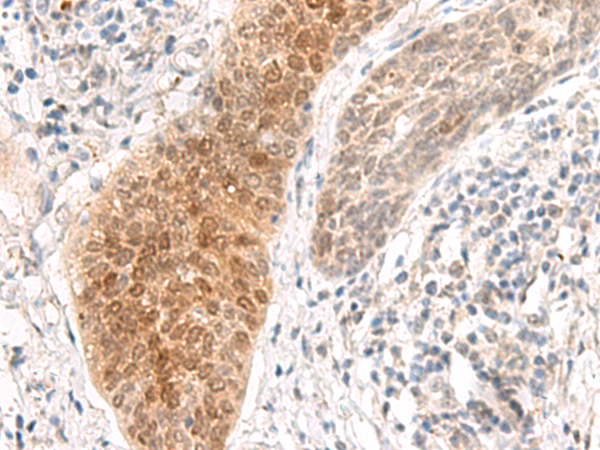 Immunohistochemistry of paraffin-embedded Human esophagus cancer tissue using TA372616 (GHDC Antibody) at dilution 1/90 (Original magnification: x200)