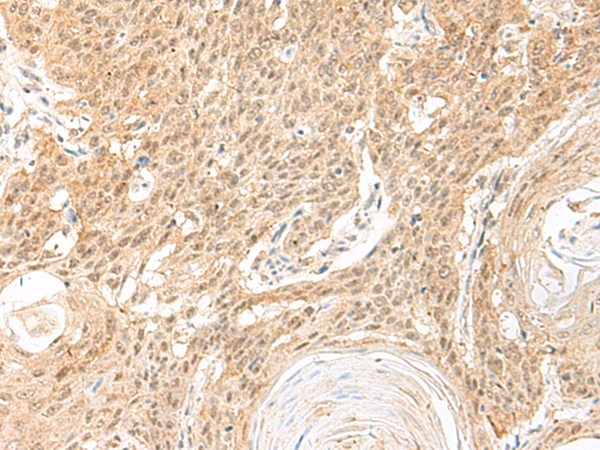 Immunohistochemistry of paraffin-embedded Human esophagus cancer tissue using TA372622 (BICRA Antibody) at dilution 1/60 (Original magnification: x200)