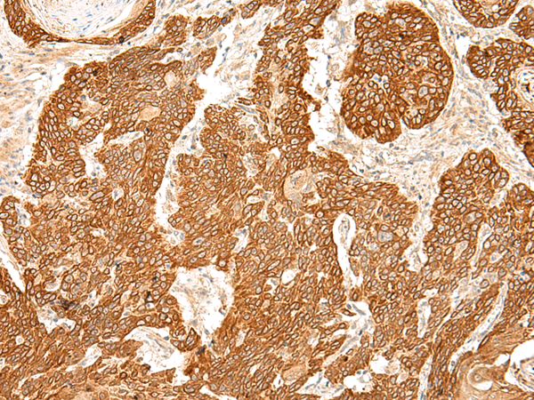 Immunohistochemistry of paraffin-embedded Human esophagus cancer tissue using TA372626 (SLC6A9 Antibody) at dilution 1/50 (Original magnification: x200)