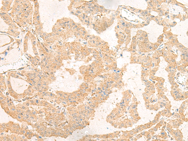 Immunohistochemistry of paraffin-embedded Human thyroid cancer tissue using TA372629 (GNAT3 Antibody) at dilution 1/40 (Original magnification: x200)