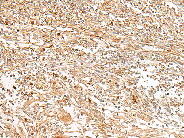 Immunohistochemistry of paraffin-embedded Human liver cancer tissue using TA372634 (GPR151 Antibody) at dilution 1/30 (Original magnification: x200)