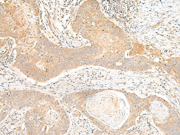 Immunohistochemistry of paraffin-embedded Human esophagus cancer tissue using TA372635 (C5AR2 Antibody) at dilution 1/25 (Original magnification: x200)
