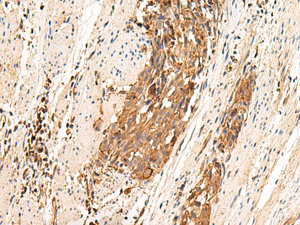 Immunohistochemistry of paraffin-embedded Human esophagus cancer tissue using TA372670 (MRGPRD Antibody) at dilution 1/25 (Original magnification: x200)