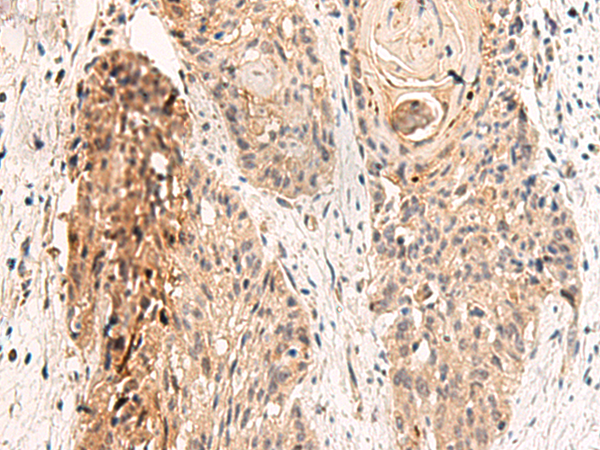 Immunohistochemistry of paraffin-embedded Human esophagus cancer tissue using TA372675 (GPR152 Antibody) at dilution 1/45 (Original magnification: x200)