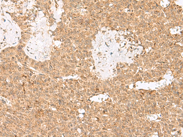 Immunohistochemistry of paraffin-embedded Human ovarian cancer tissue using TA372692 (LGALSL Antibody) at dilution 1/25 (Original magnification: x200)