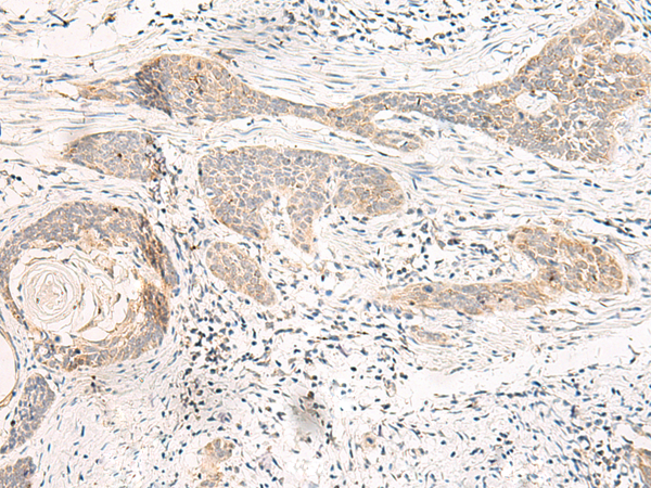 Immunohistochemistry of paraffin-embedded Human esophagus cancer tissue using TA372701 (GUCY1B2 Antibody) at dilution 1/20 (Original magnification: x200)