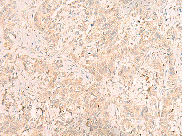 Immunohistochemistry of paraffin-embedded Human ovarian cancer tissue using TA372768 (IL1RAPL2 Antibody) at dilution 1/20 (Original magnification: x200)