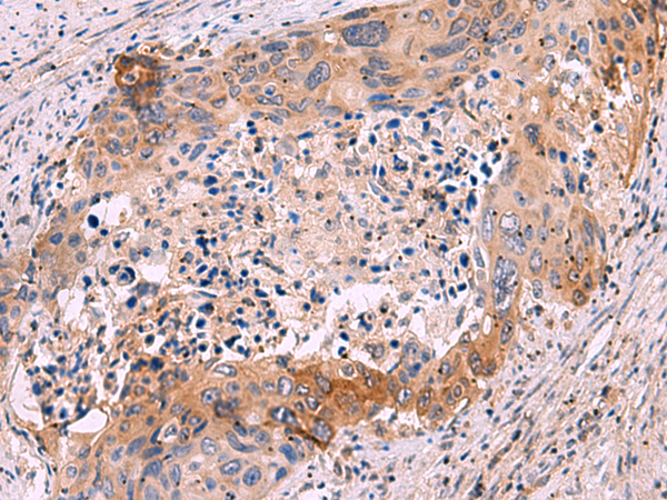 Immunohistochemistry of paraffin-embedded Human cervical cancer tissue using TA372823 (GRIK4 Antibody) at dilution 1/50 (Original magnification: x200)