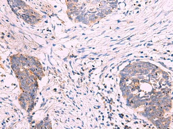 Immunohistochemistry of paraffin-embedded Human esophagus cancer tissue using TA372830 (KANSL1L Antibody) at dilution 1/30 (Original magnification: x200)
