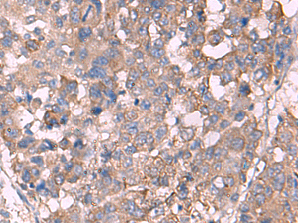 Immunohistochemistry of paraffin-embedded Human liver cancer tissue using TA372847 (KCNN3 Antibody) at dilution 1/60 (Original magnification: x200)