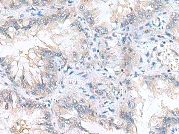 Immunohistochemistry of paraffin-embedded Human lung cancer tissue using TA372864 (CAMSAP3 Antibody) at dilution 1/90 (Original magnification: x200)