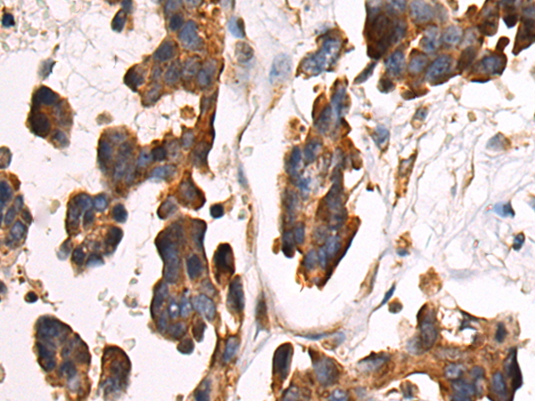 Immunohistochemistry of paraffin-embedded Human colorectal cancer tissue using TA372873 (ARRDC4 Antibody) at dilution 1/35 (Original magnification: x200)
