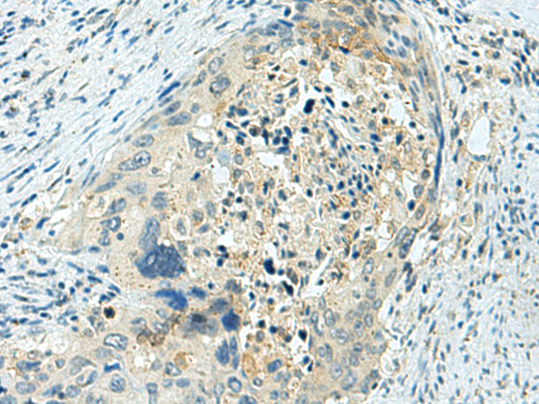 Immunohistochemistry of paraffin-embedded Human cervical cancer tissue using TA372899 (HSPB11 Antibody) at dilution 1/20 (Original magnification: x200)
