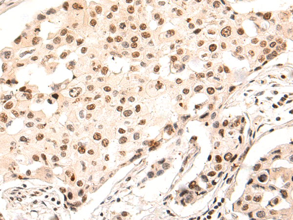 Immunohistochemistry of paraffin-embedded Human breast cancer tissue using TA372923 (UBR5 Antibody) at dilution 1/55 (Original magnification: x200)