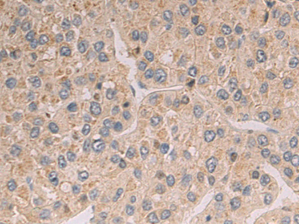 Immunohistochemistry of paraffin-embedded Human liver cancer tissue using TA372954 (SLC22A7 Antibody) at dilution 1/100 (Original magnification: x200)