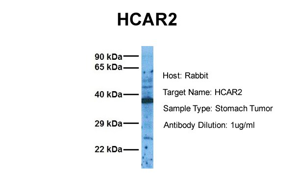 Host: Rabbit Target Name: HCAR2 Sample Tissue: Human Stomach Tumor Antibody Dilution: 1.0ug/ml