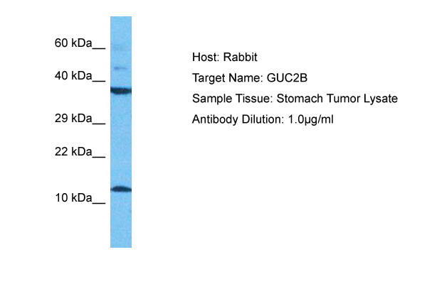 Figure 1. Immunohistochemical staining using microphthalmia antibody on formalin fixed, paraffin embedded human melanoma.
