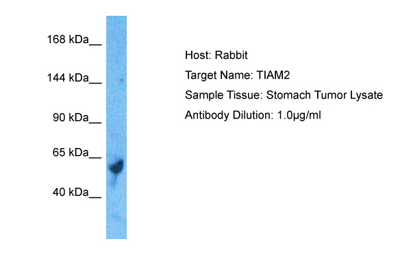 Host: Rabbit Target Name: TIAM2 Sample Tissue: Human Stomach Tumor Antibody Dilution: 1.0ug/ml