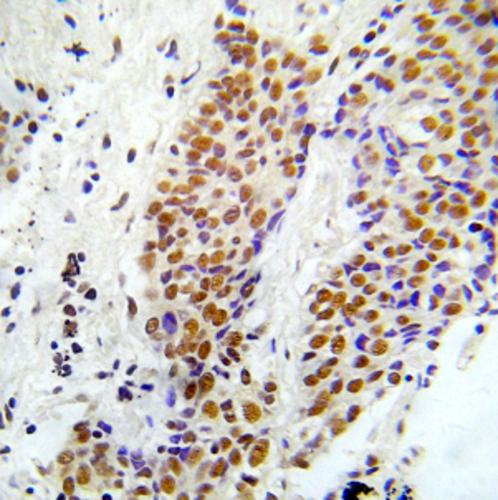 Immunohistochemical analysis of paraffin-embedded human lung adenocarcinoma tissue using ASK1 (Phospho-Ser966) Antibody.