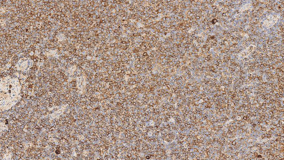B cell chronic lymphocytic leukemia: immunohistochemical staining for Lambda Light Chain. Lambda Light Chain: clone SHL53