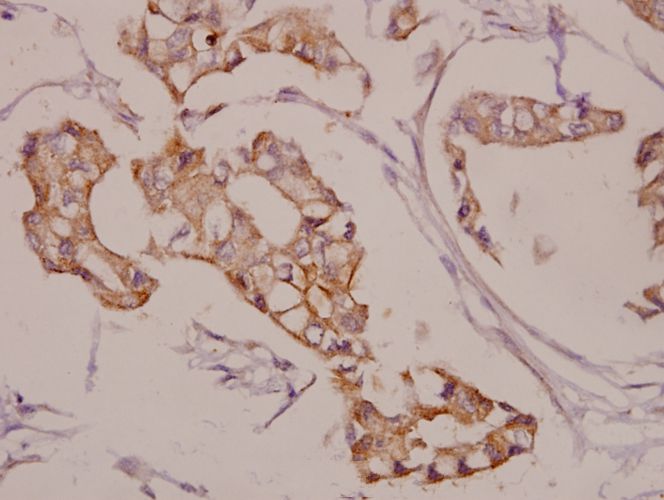 Immunohistochemistry (IHC) analyzes of AKAP5 (E7) pAb in paraffin-embedded human breast carcinoma tissue at 1:50.