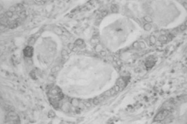 IHC on human uterine cervical adenocarcinoma