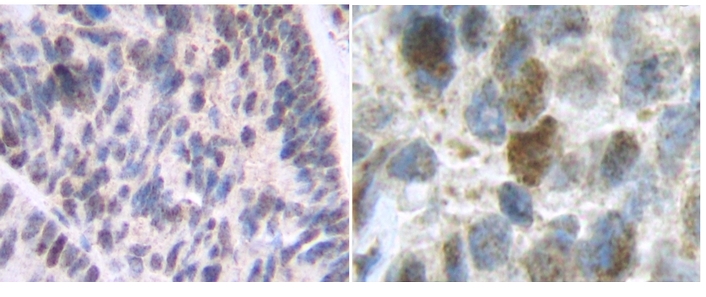 Formalin-fixed, paraffin-embedded sections of human breast invasive ductal carcinoma stained with Osteoprotegerin Antibody Cat.-No PP1107P. Tissue samples were provided by the Cooperative Human Tissue Network which is funded by the National Cancer Institute.