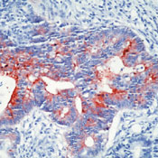 Formalin-fixed, paraffin-embedded human colon carcinoma stained with Secretory Component antibody (Cat. SM3073P) using peroxidase-conjugate and AEC chromogen. Note cytoplasmic staining of tumor cells.