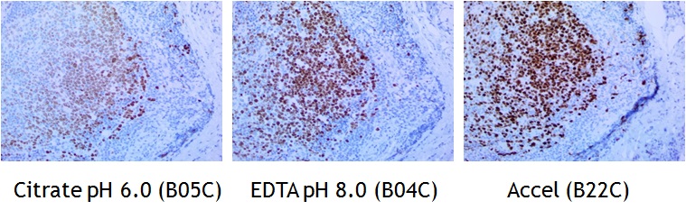 IHC staining of FFPE human tonsil tissue within normal limits using mouse anti-human Ki67 monoclonal antibody and Polink-1 HRP Broad for DAB [D11-18]. Heat-induced epitope retrieval by Citrate Buffer pH 6.0 (Cat. No.: B05C-100), EDTA Solution pH 8.0 (Cat. No.: B04C-100), and Accel Retrieval Solution (B22C-125) (15-20 minutes at 95 C-100 C). The brown stain indicates positive stain and blue is the counter stain. It is mounted using a permanent Organic mounting medium [E37-100].