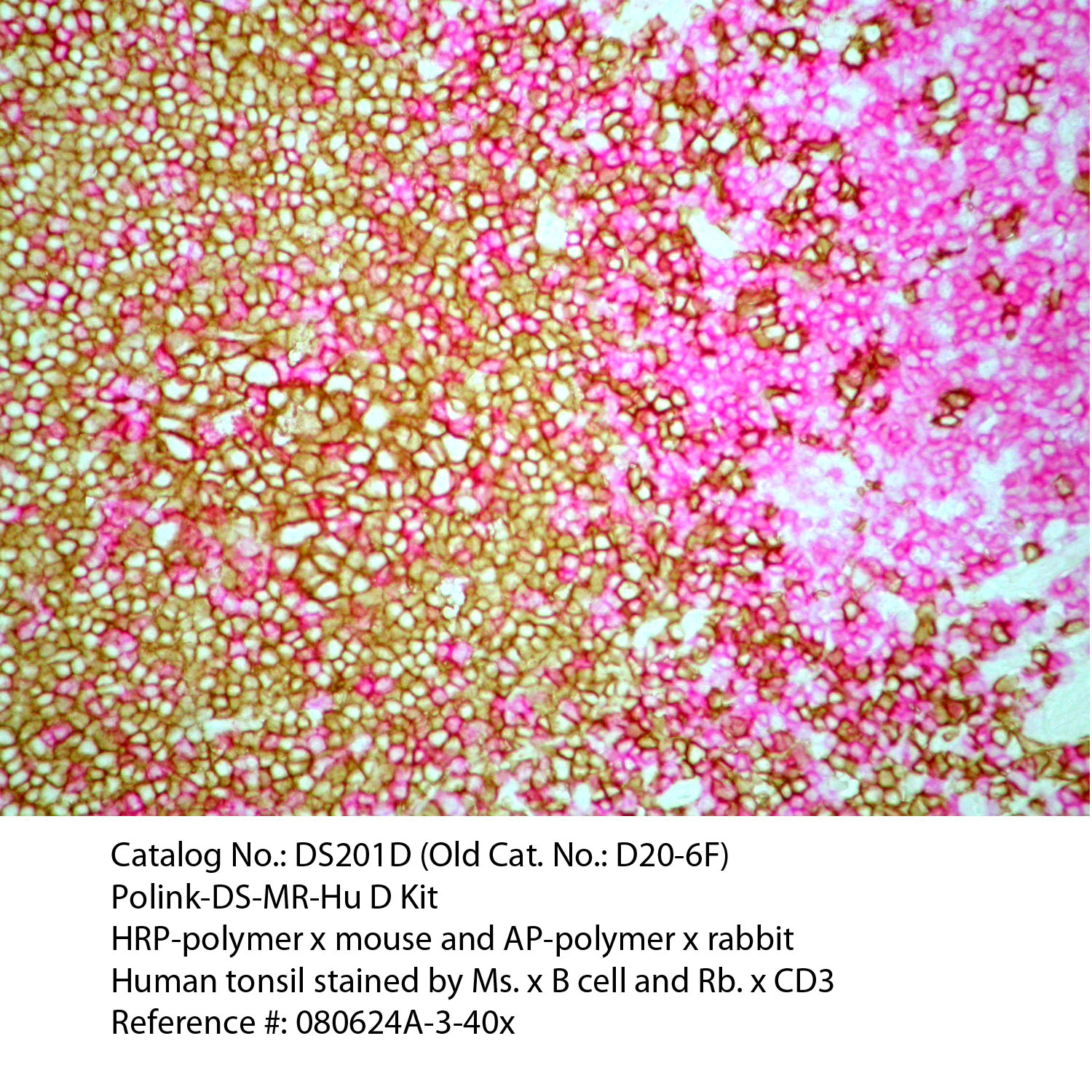 IHC staining of FFPE human tonsil tissue within normal limits using mouse anti-B cell and rabbit anti-CD3 polyclonal antibodies and Polink DS-MR-Hu A1 detection kit [DS201A-18]. The red (Rabbit anti-CD3) and brown (Mouse anti-B cell) stain indicate positive stain and blue background is the counter stain. It is mounted using a permanent aqueous mounting medium [E03-18].