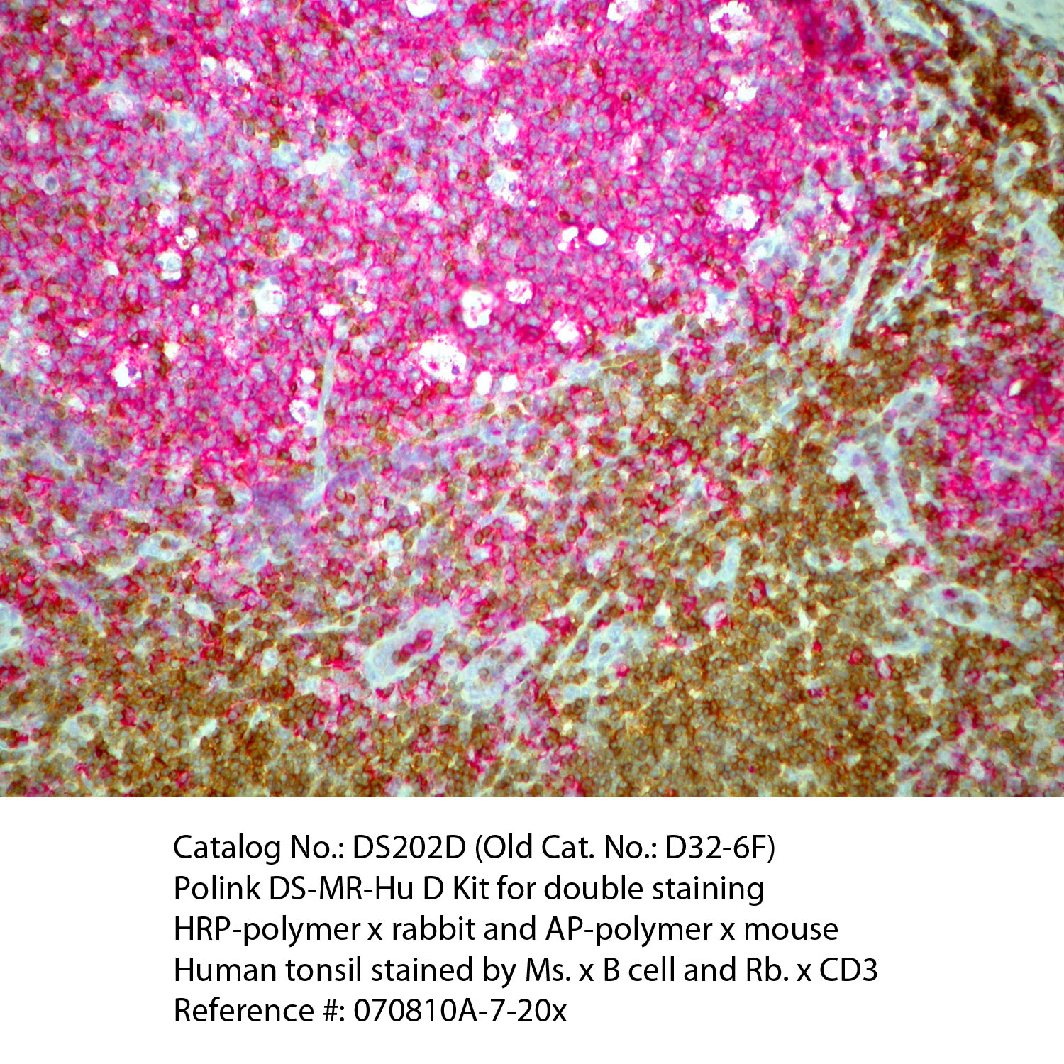 IHC staining of FFPE human tonsil tissue within normal limits using mouse anti-B cell and rabbit anti-CD3 polyclonal antibodies and Polink DS-MR-Hu A2 detection kit [DS202A-18]. The red (Mouse anti-B cell) and brown (Rabbit anti-CD3) stain indicate positive stain and blue background is the counter stain. It is mounted using a permanent aqueous mounting medium [E03-18].